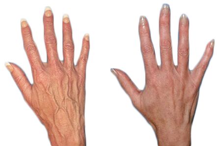 The effect of Neoveris for the treatment of varicose veins in the hands